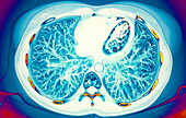 Heart and lungs, CT scan