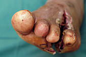 Diabetic septic foot