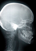 Skull, X-ray