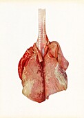 Lungs of a dog gassed with chlorine, illustration