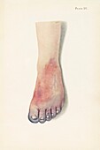 Gangrene of a foot from chlorine poisoning, illustration