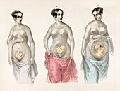 Stages of pregnancy, 19th century illustration