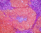 Amyloidosis, LM