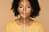 Vitiligo treatment, conceptual image