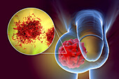 Testicular cancer, illustration