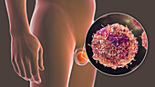 Testicular cancer, illustration