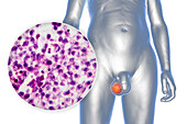 Testicular cancer, illustration and light micrograph