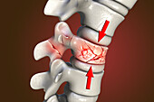 Spinal compression fracture, illustration
