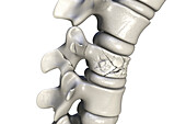 Spinal fracture, illustration