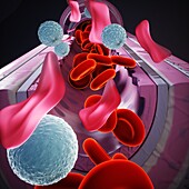 Thalassemia, illustration