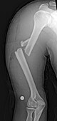 Fractured arm, X-ray