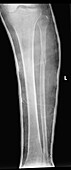 Fractured leg in cast, X-ray