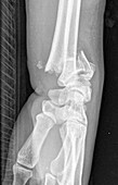 Colles fracture, X-ray