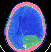 Meningioma, CT scan