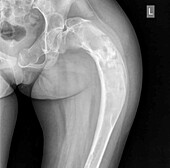 Fibrous dysplasia, X-ray