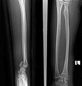 Smith fracture, X-ray