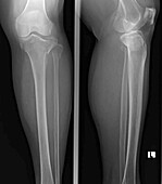 Tibial plateau fracture, X-ray