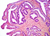 Cholecystitis, LM