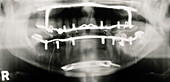 Post-operative x-ray of jaw