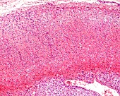 Waterhouse-Friderichsen syndrome, light micrograph