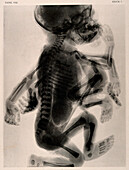 Skeleton of child with extra limbs and deformed head, x-ray