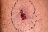 Squamous cell carcinoma marked before skin excision surgery