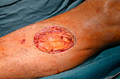 Hole left after excision of squamous cell carcinoma
