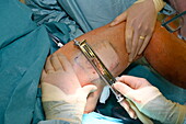 Surgeon using a skin graft knife to harvest skin