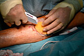 Skin graft dressing being secured into place with staples