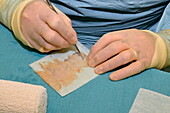 Surgeon preparing skin graft