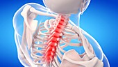 Painful cervical spine, illustration