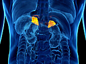 Adrenal gland cancer, illustration