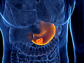 Stomach cancer, illustration