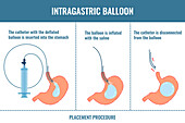 Gastric balloon, conceptual illustration