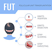 FUT hair transplantation in women, illustration