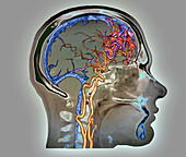 Arteriovenous malformation, CT angiogram