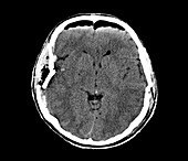 Traumatic brain injury, CT scan