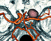 Subarachnoid hemorrhage, CT angiogram