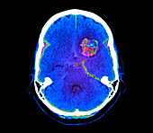 Subarachnoid haemorrhage, CT scan