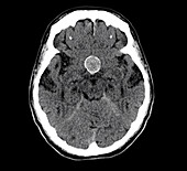 Suprasellar aneurysm, CT scan