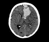 Brain haemorrhage, CT scan