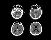 Brain haemorrhage, CT scans