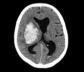 Cerebral haemorrhage, CT scan