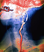 Narrowed carotid artery, digital angiogram