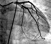 Normal left coronary network, angiogram