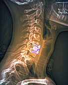 Treatment of spinal disc herniation, X-ray