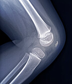 Knee of a child, X-ray