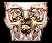 Normal skull, CT scan