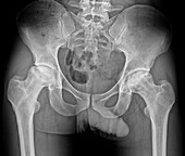 Painful hips, X-ray