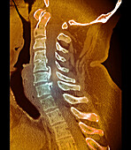 Osteoarthritis of the cervical spine, CT scan